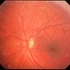 Intermediate Uveitis and CME